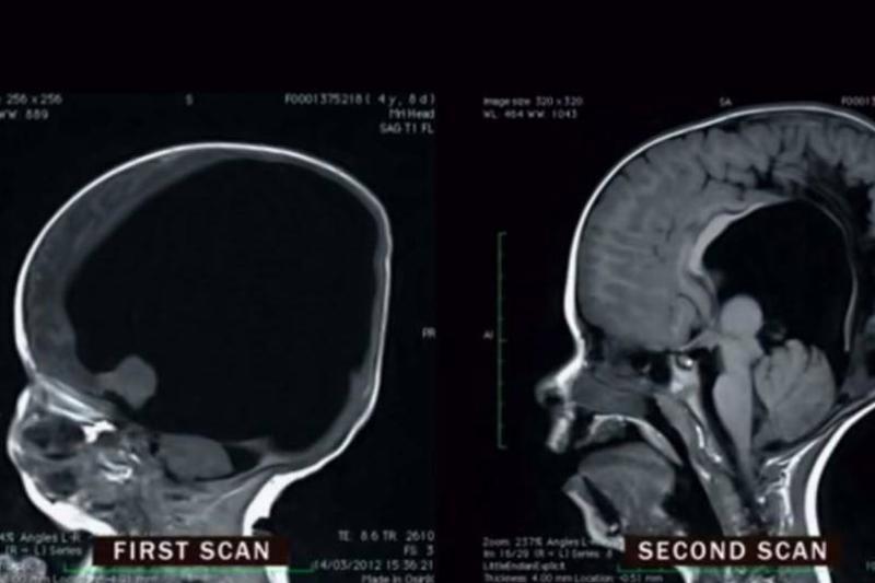 noah's brain scan showing its growth