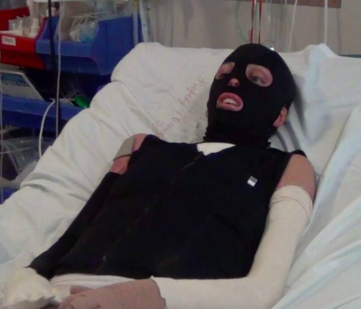 A woman wearing a body and face mask, in a hospital bed.