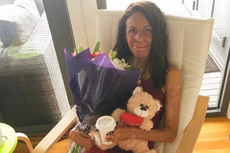 A woman with burn marks sitting in a chair holding flowers and a teddy bear.