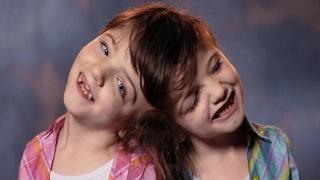 coinjoined twins smile for picture