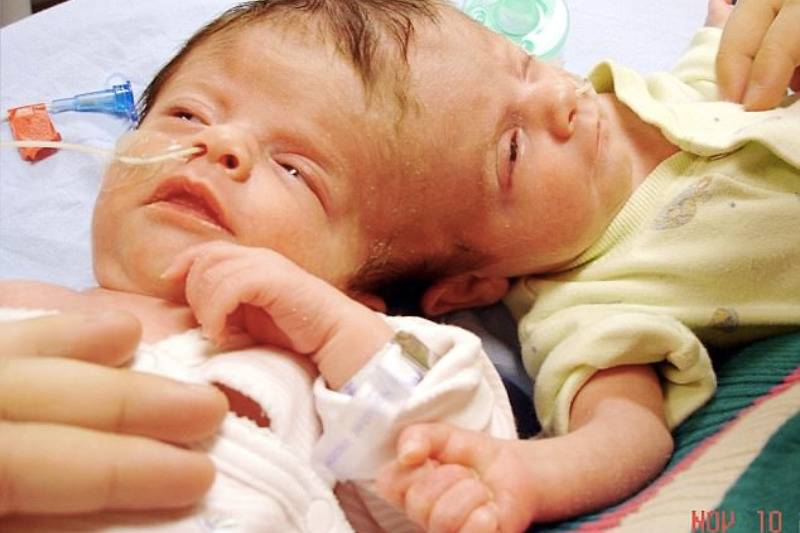 conjoined twins at birth in hospital