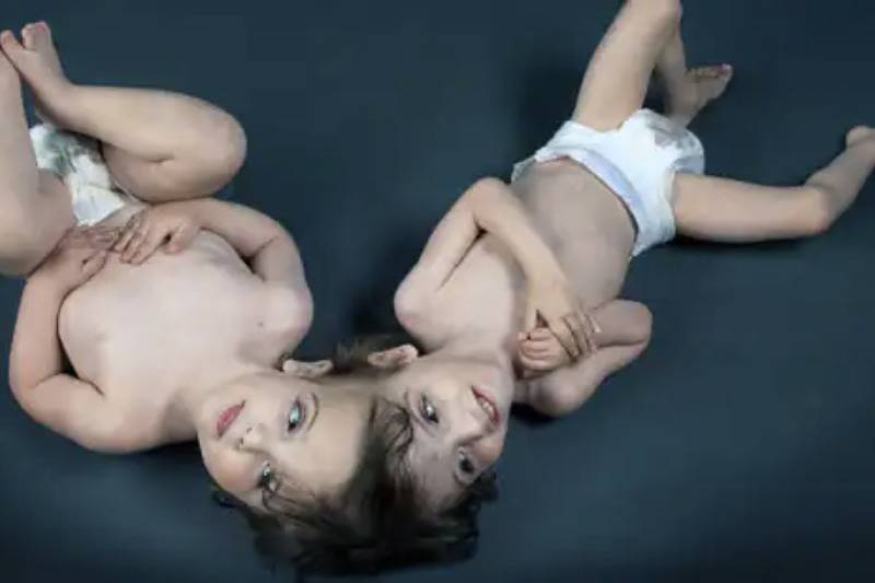 conjoined twins in diapers