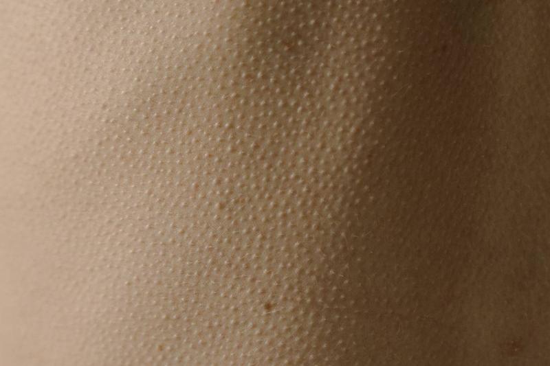 goosebump pattern on skin