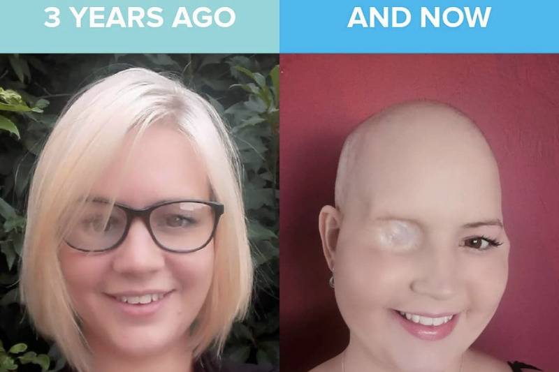Toni before and after cancer side by side
