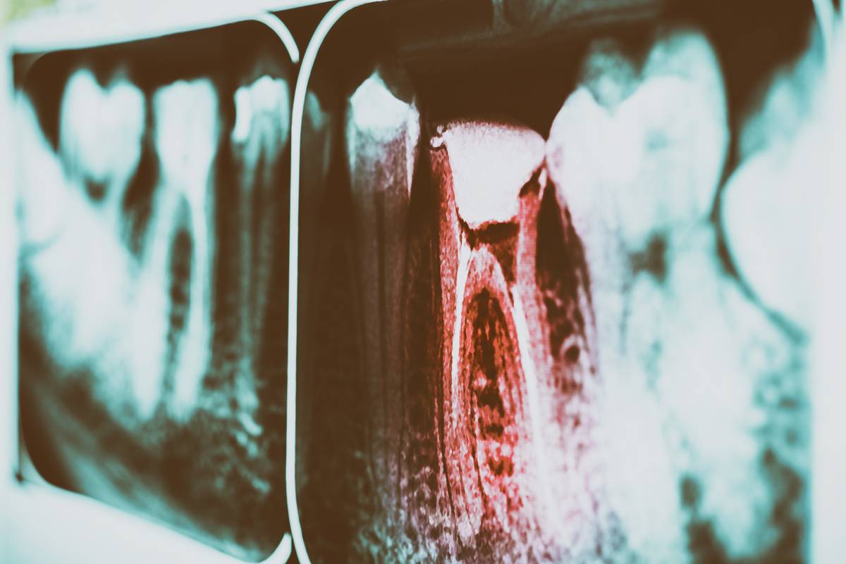 A tooth x-ray that displays one of the teeth in a bright red.