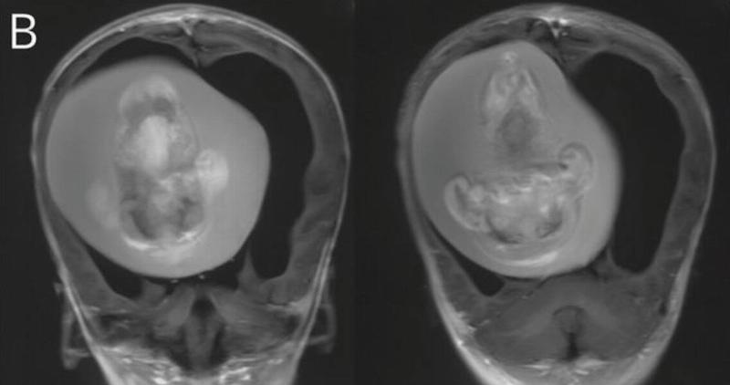 Brain scans of the girl's brain featuring the parasitic twin inside.