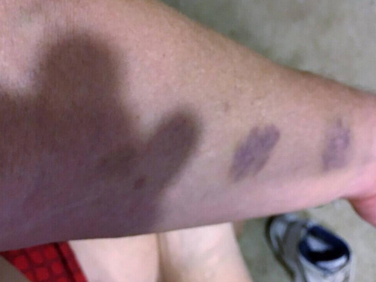 Mysterious bruises John found on his arm, no recollection of how they got there.