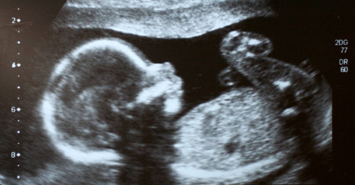A clear view of a baby in al ultrasound.