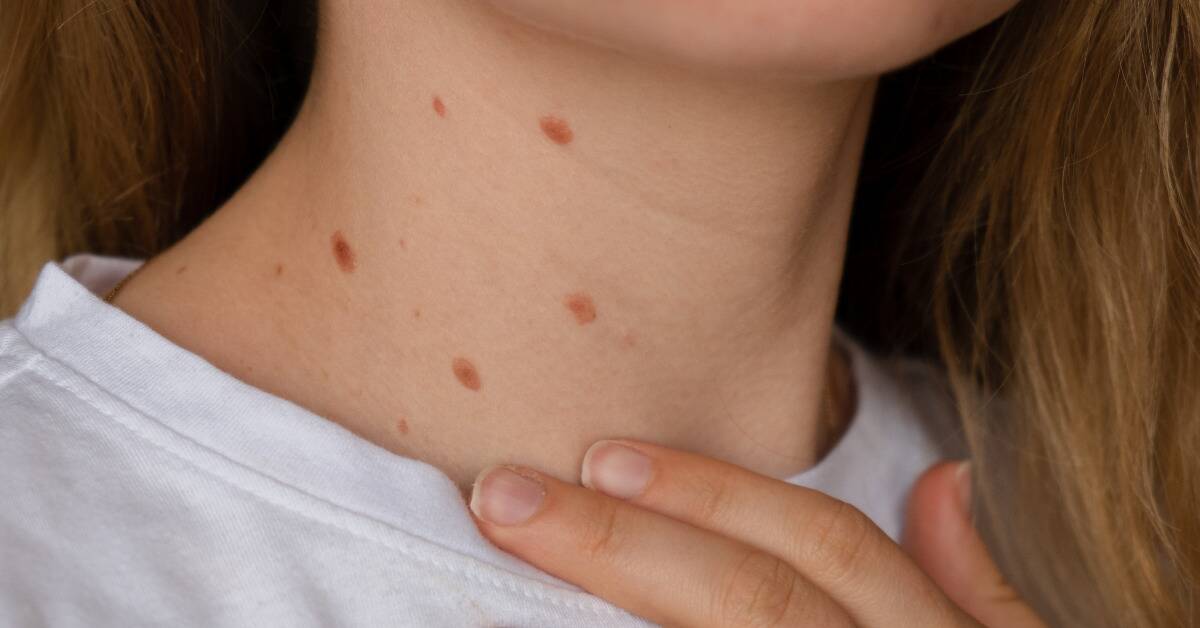 A woman with 5 small birthmarks in a circular formation on his neck.