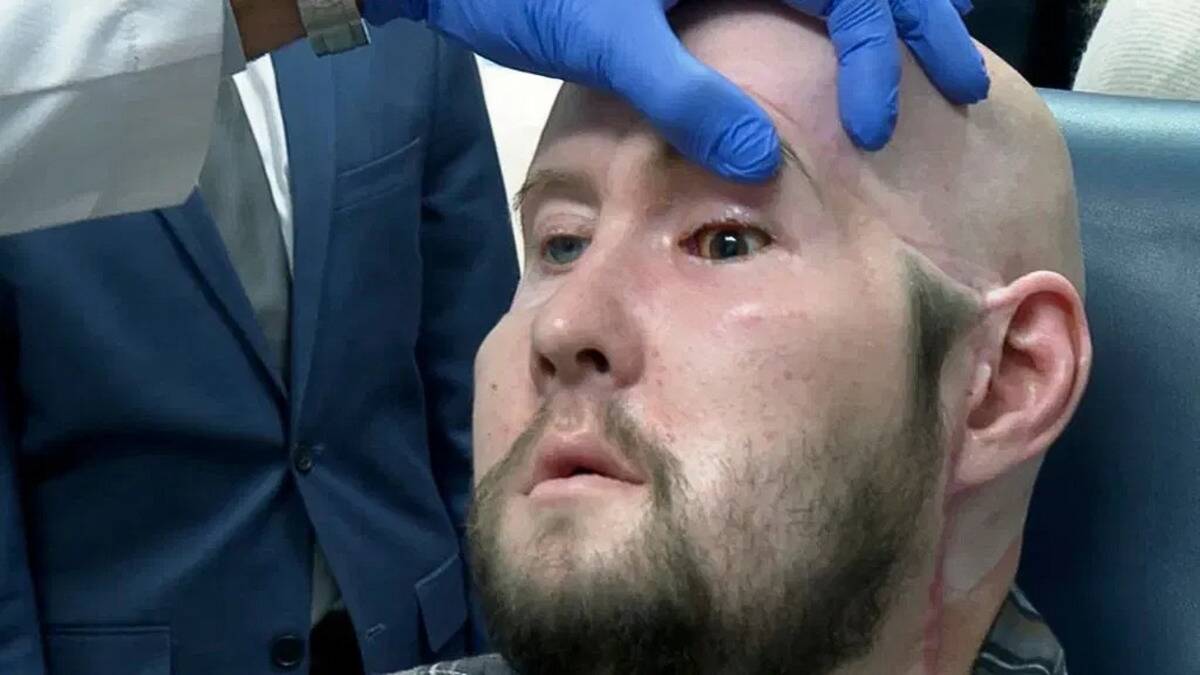 A close photo of Aaron's eye transplant being checked by a doctor.