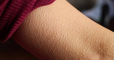 A closeup of someone's arm that's covered in goosebumps.