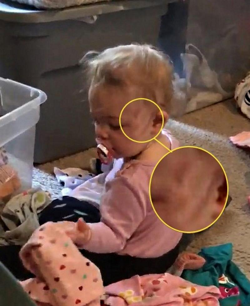 scratches on baby circled in yellow